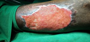 Large ulcer treatment - ST Hospital Kumbakonam